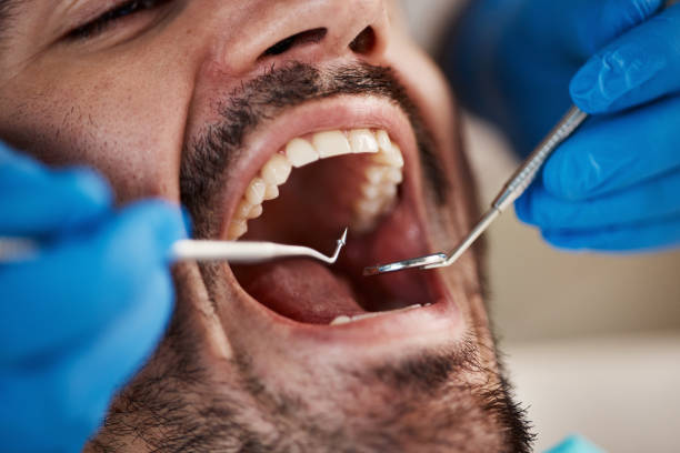 Best Emergency Dentist for Lost Fillings or Crowns in Cedar Knolls, NJ